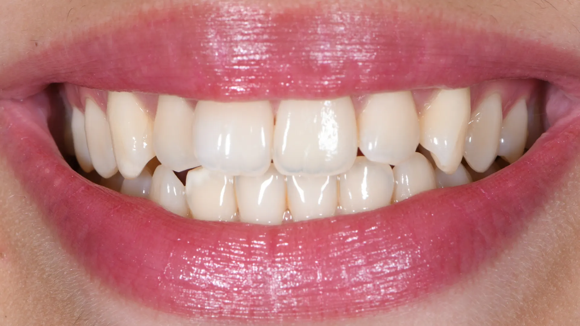 Teeth slider 1 after - Dr Carol Gallego