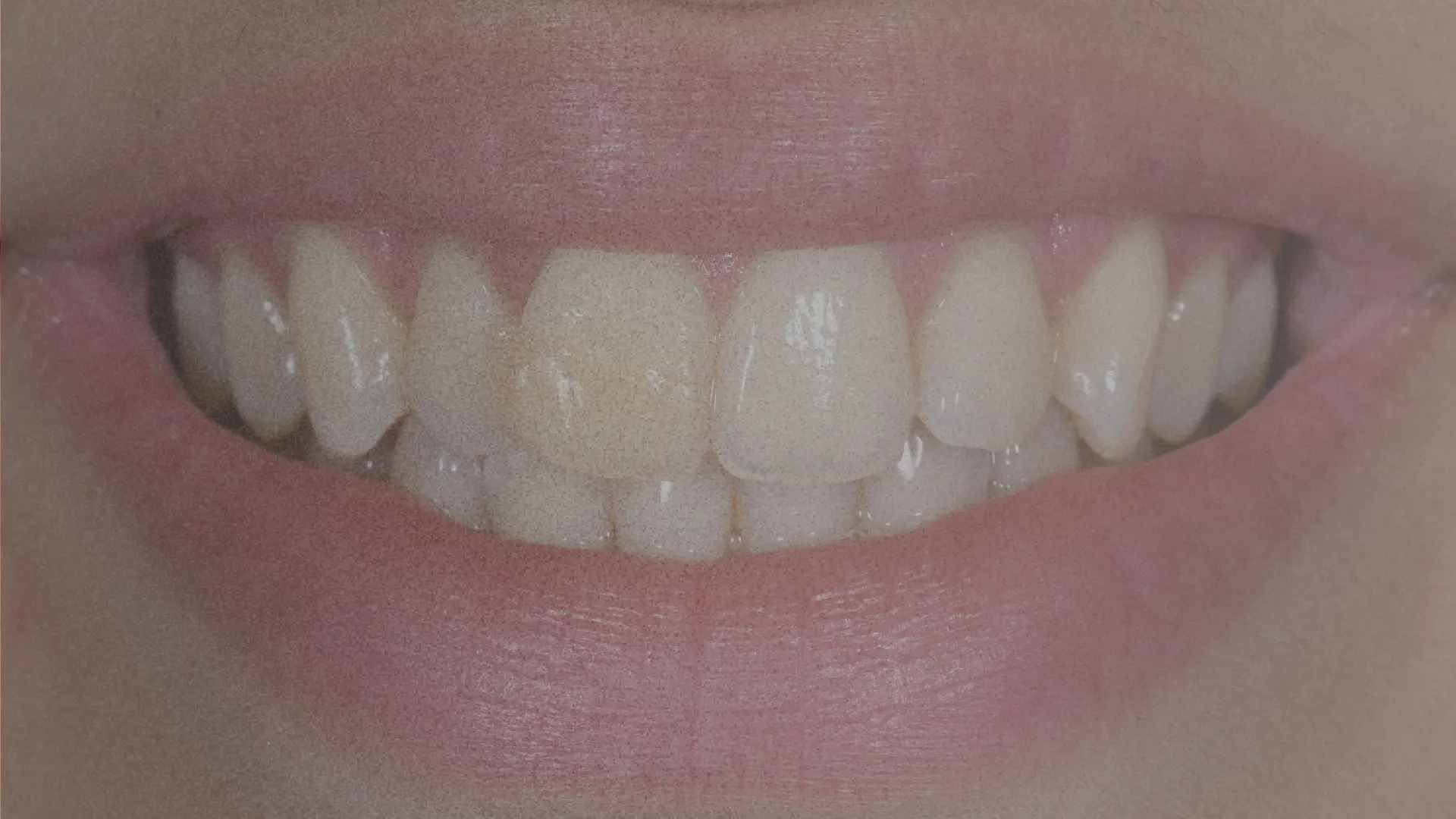 Teeth slider 1 before - Dr Carol Gallego