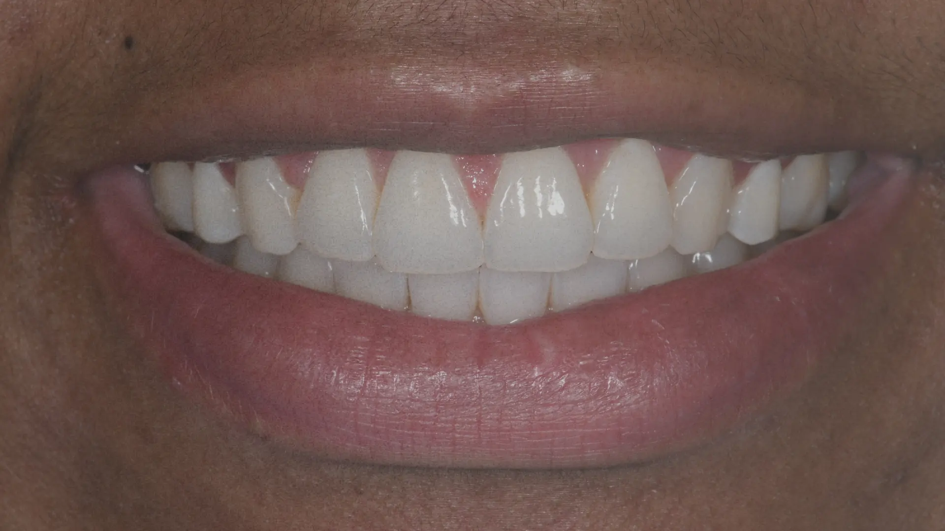 Teeth slider 2 before - Dr Carol Gallego
