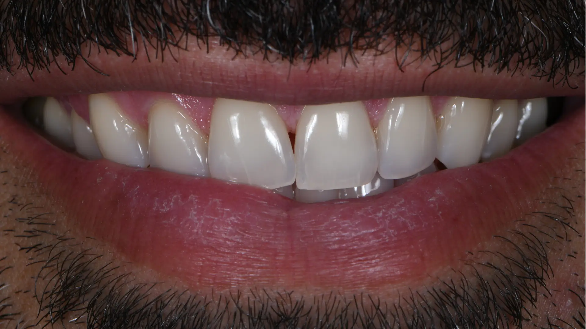 Teeth slider 3 after - Dr Carol Gallego