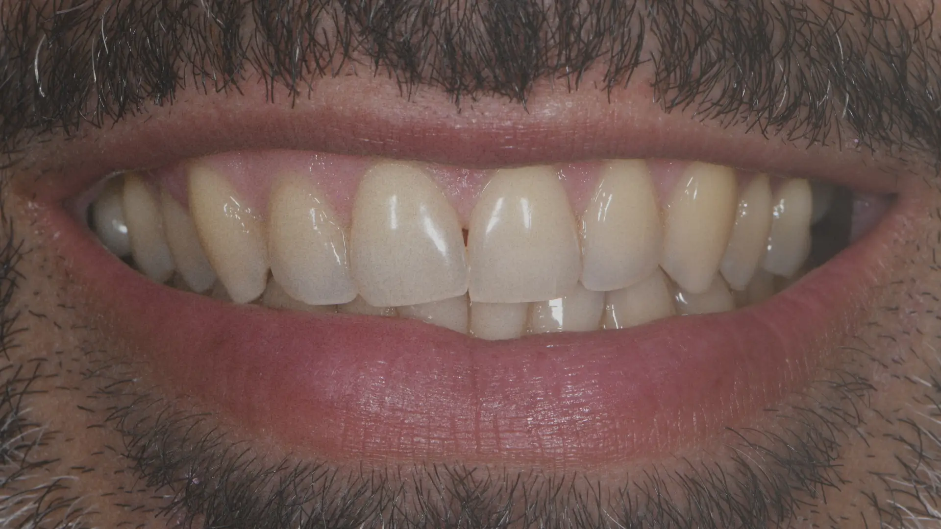 Teeth slider 3 before - Dr Carol Gallego