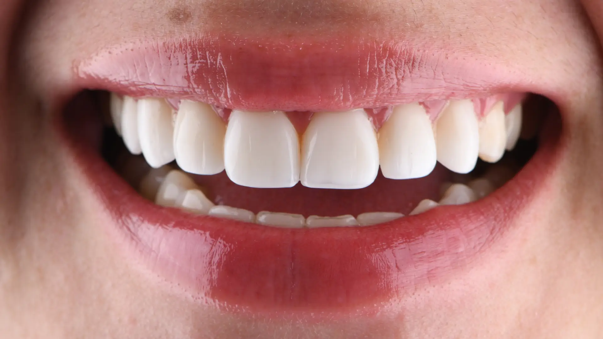 Teeth slider 4 after - Dr Carol Gallego