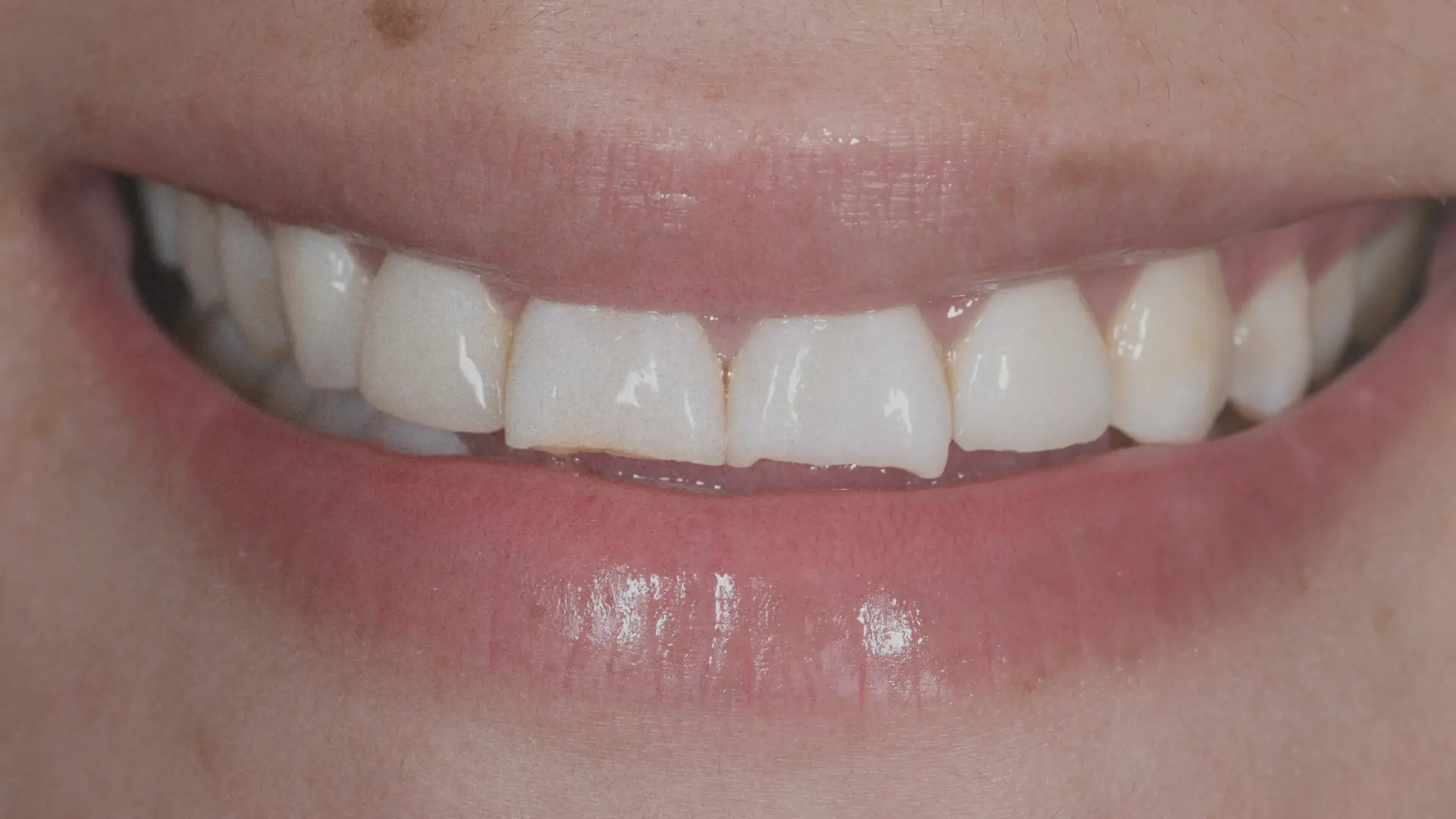 Teeth slider 4 before - Dr Carol Gallego