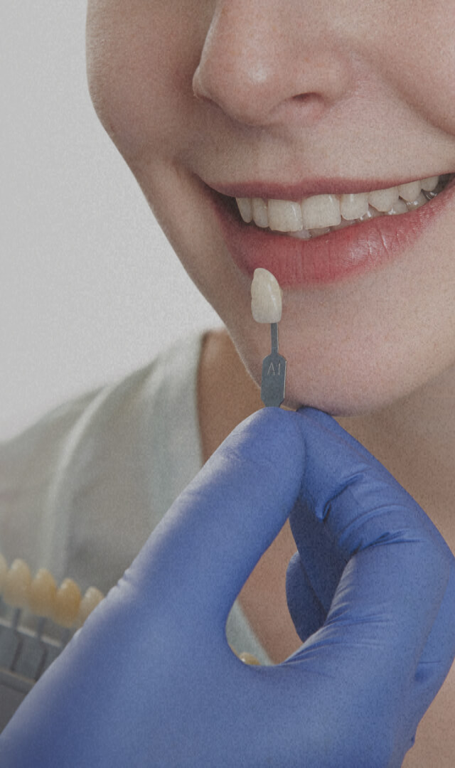 ceramic-veneers
