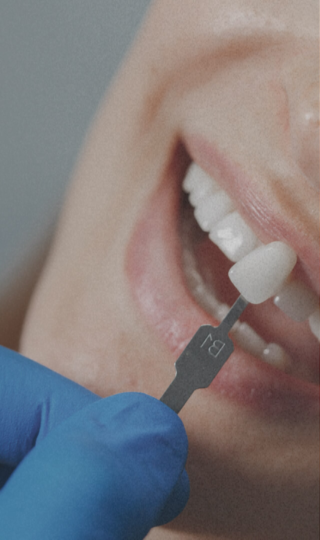 composite-veneers