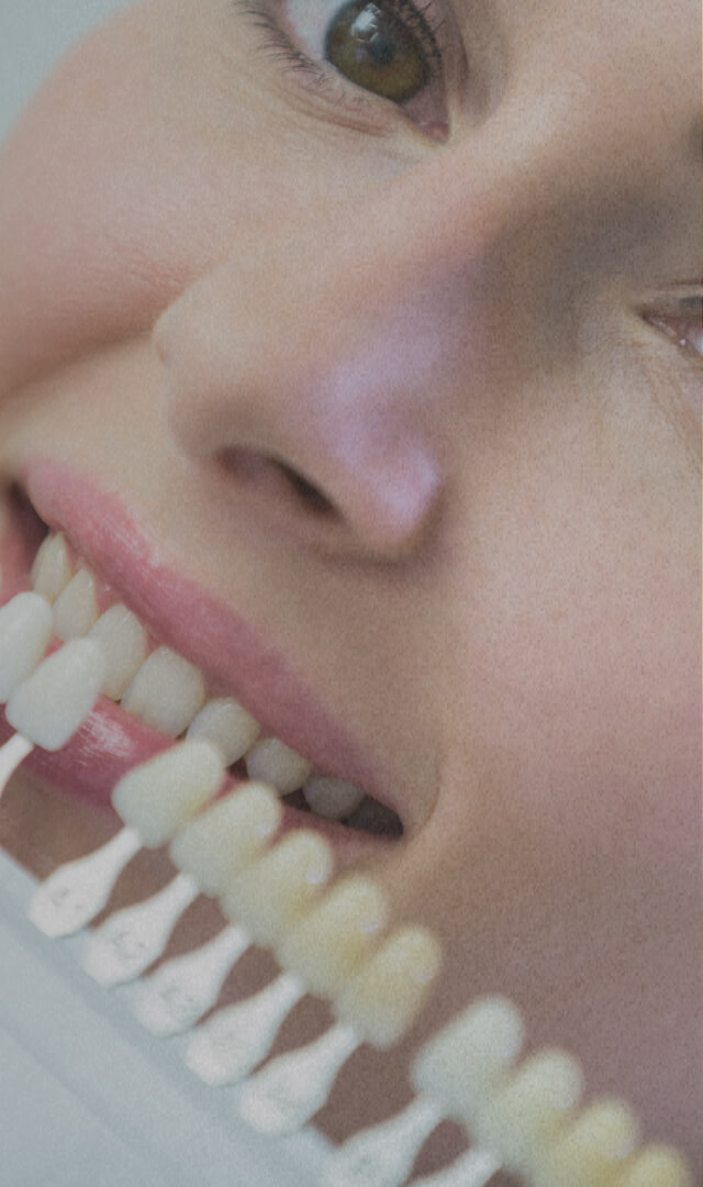 porcelain-veneers