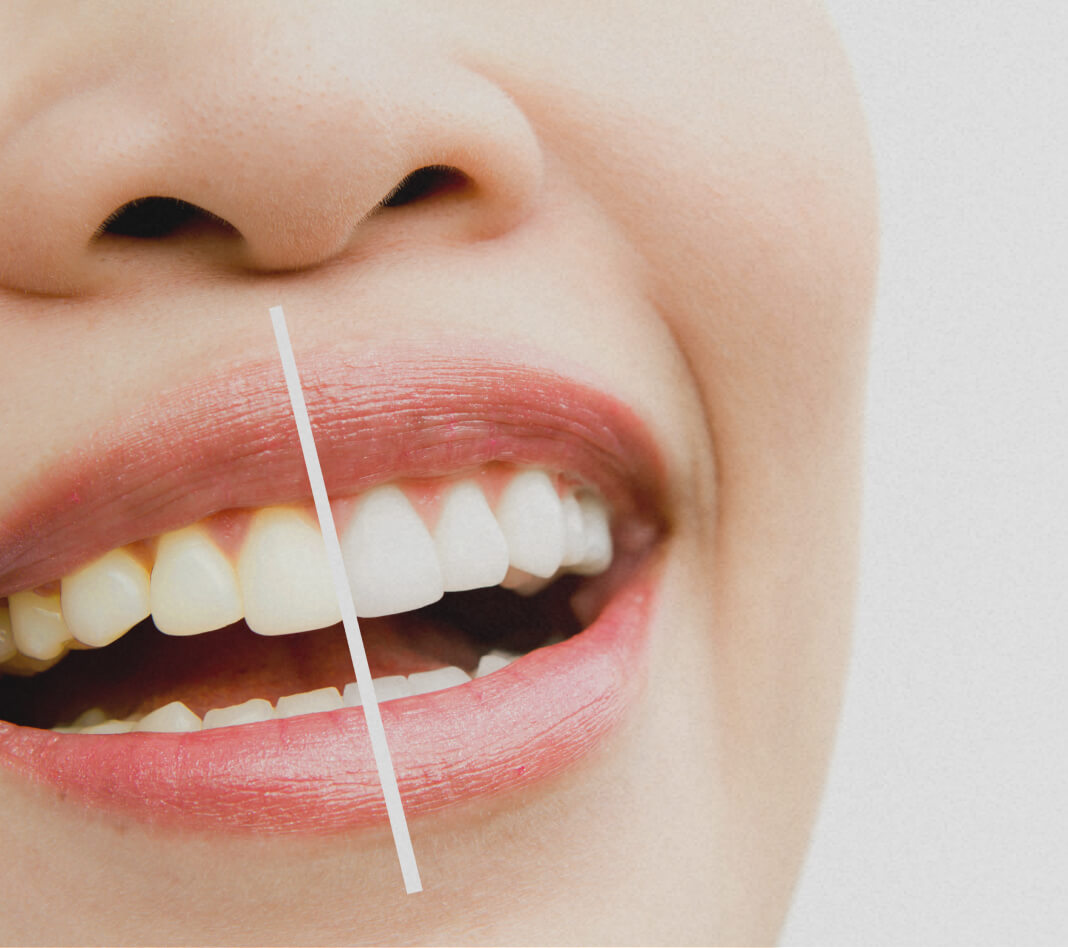 Teeth whitening