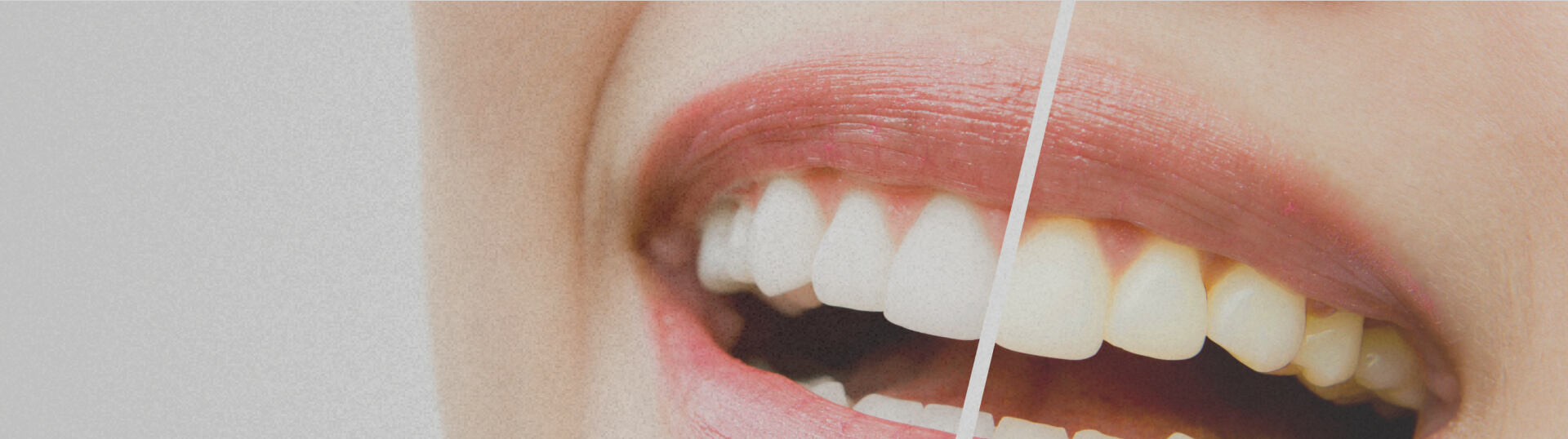 teeth-whitening-services-poster