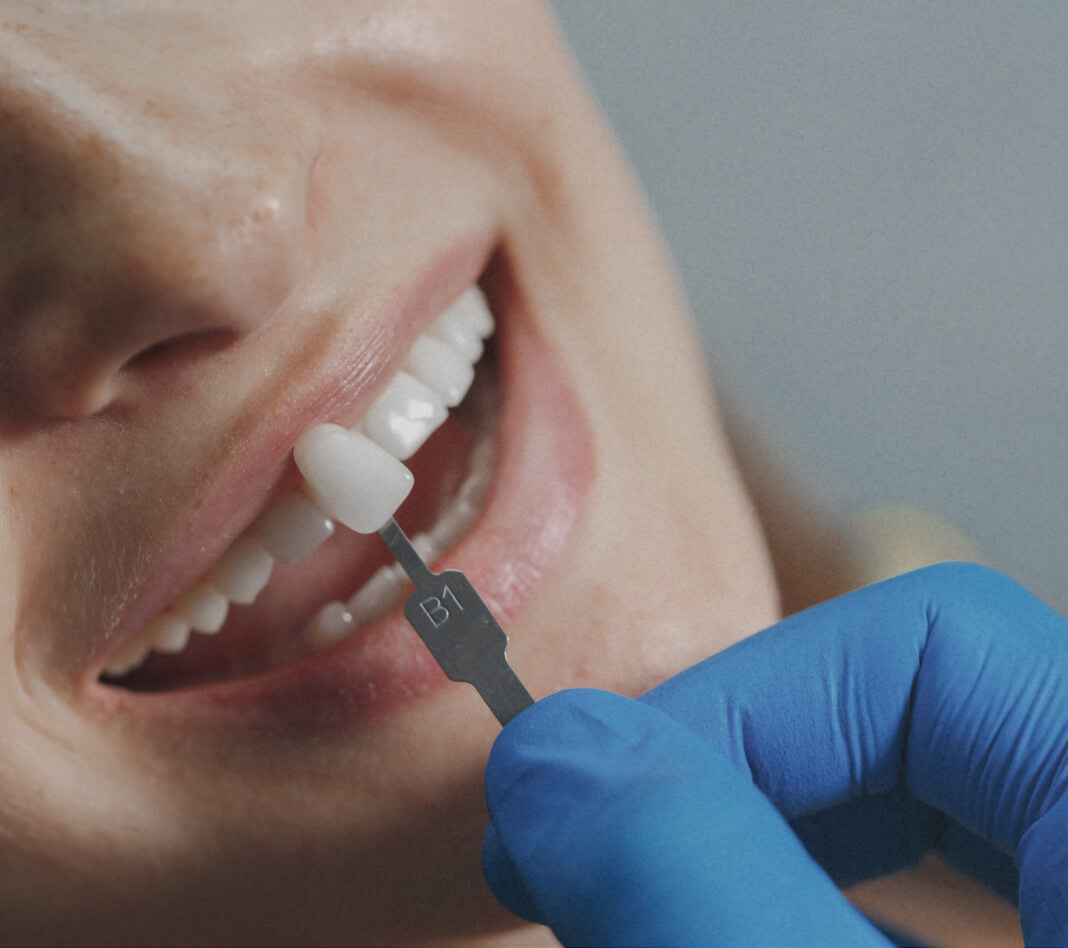 Veneers