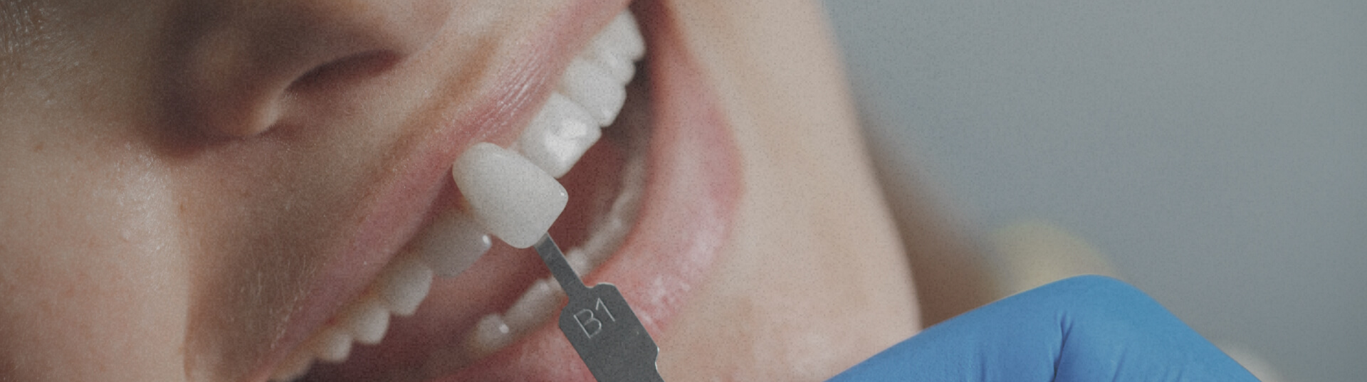 veneers-services-poster-1